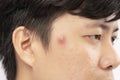 Close up photo of acne prone skin, a man squeezing his pimple