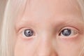 Close-up photo of albino child eyes