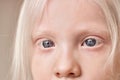 Close-up photo of blue eyes of albino child girl