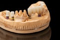 Close-up photo of a dental lower jaw prosthesis on black glass background. Artificial jaw with veneers and crowns. Tooth