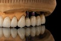 Close-up photo of a dental upper jaw prosthesis on black glass background. Artificial jaw with veneers and crowns. Tooth