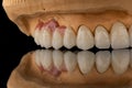 Close-up photo of a dental upper jaw prosthesis on black glass background. Artificial jaw with veneers and crowns. Tooth