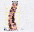 Close-up photo of the DEXA test - osteodensimetry of the spine, which measures bone density using X-rays, the imaging method used