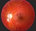 human eye retina showing blood vessels