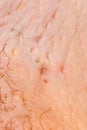 Ingrown hair after shaving