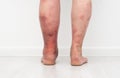 Close up photo of legs with lymphostasis from behind. Royalty Free Stock Photo