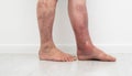 Close up photo of legs with lymphostasis and psoriasis. Royalty Free Stock Photo