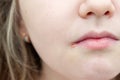 Close up photo of little girl lips affected by herpes. Treatment of herpes infection and virus Royalty Free Stock Photo