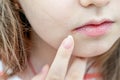 Close up photo of little girl lips affected by herpes. Treatment with ointment Royalty Free Stock Photo