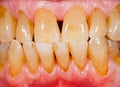 Porcelain, zirconia teeth in human mouth Royalty Free Stock Photo
