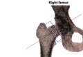 Close-up photo of the right femoral DEXA-osteodensimetry test, which measures bone density using X-rays, the imaging method used