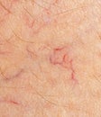 Spider veins, dilated blood vessels Royalty Free Stock Photo