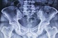 X-ray image of human pelvic Royalty Free Stock Photo