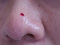 Close up picture of bleeding from popping blackheads on the nose. Problem of blackheads , whiteheads, uneven skin, pimples Royalty Free Stock Photo