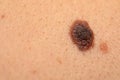 Dangerous nevus on skin - melanoma Royalty Free Stock Photo