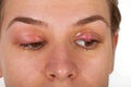 Hordeolum on upper eyelid. Viral infection