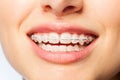 Healthy smile woman with clear brackets