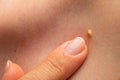 Papilloma on human skin Royalty Free Stock Photo