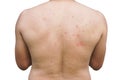 Picture of a patient with eczema, ringworm on the skin of the back.Medical healthcare and Education concept Royalty Free Stock Photo