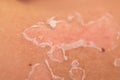 Skin peeling after sunburn Royalty Free Stock Photo