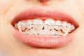 Teeth with dental braces and elastics full mouth