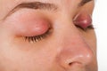 Upper eyelid infection - chalazion Royalty Free Stock Photo