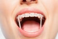 Woman mouth with orthodontic elastics on braces