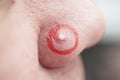 close-up of pimple Royalty Free Stock Photo