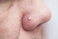 close-up of pimple Royalty Free Stock Photo