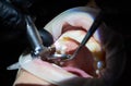 Close-up of polishing teeth. Dental services in modern clinic Royalty Free Stock Photo