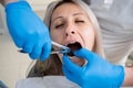 poor girl& x27;s mouth in the bib of the patient in the dental clinic. A dentist in blue latex gloves removes her tooth