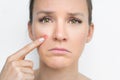 Sad woman face with pimple on her cheek. Acne, problem skin. Face skin care Royalty Free Stock Photo