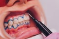 Close-up portrait of a female patient visiting dentist for teeth whitening in clinic,Teeth whitening procedure. Royalty Free Stock Photo