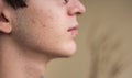 Close-up portrait on the skin of a young Caucasian boy in pubertal age: on his skin there are several recognizable pimples at Royalty Free Stock Photo