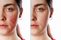 A close-up portrait of a young Caucasian woman showing redness and inflamed blood vessels on her cheeks. Isolate. Before and after