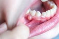 Close-up of a problem into kids mouth. Blister, pustule on the gums of a milk teeth of a small child Royalty Free Stock Photo