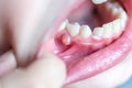 Close-up of a problem into kids mouth. Blister, pustule on the gums of a milk teeth of a small child