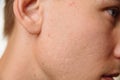 Acne scars on the face Royalty Free Stock Photo