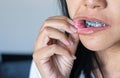 Close up of pus on mouth or lip asian woman,Oral health problems concept Royalty Free Stock Photo