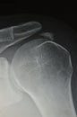 Close-up of radiography of painfull shoulder, calc Royalty Free Stock Photo