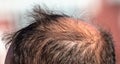 Close-up of a receding hairline on a man's head