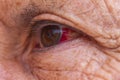 Close up of red eye or or bloodshot eyes which can be the sign of a minor irritation or a serious medical condition Royalty Free Stock Photo