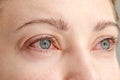 Close up of red irritated human eyes, allergy symptom, conjunctivitis Royalty Free Stock Photo