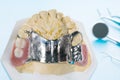 Removable partial denture RPD. Royalty Free Stock Photo