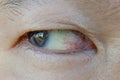 Close-up of right eye of Asian man with eye irritation problem