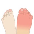 Right-foot swollen infection sting allergy injury in comparison to the normal left foot, illustration on white background
