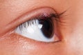 Close up right upper eye lid abscess. Royalty Free Stock Photo