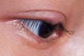 Close up right upper eye lid abscess Royalty Free Stock Photo