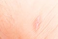 Close up on scar on leg, upon recovery Royalty Free Stock Photo