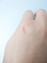 Close up, selective focus on a small cut on a hand, near the knuckle area